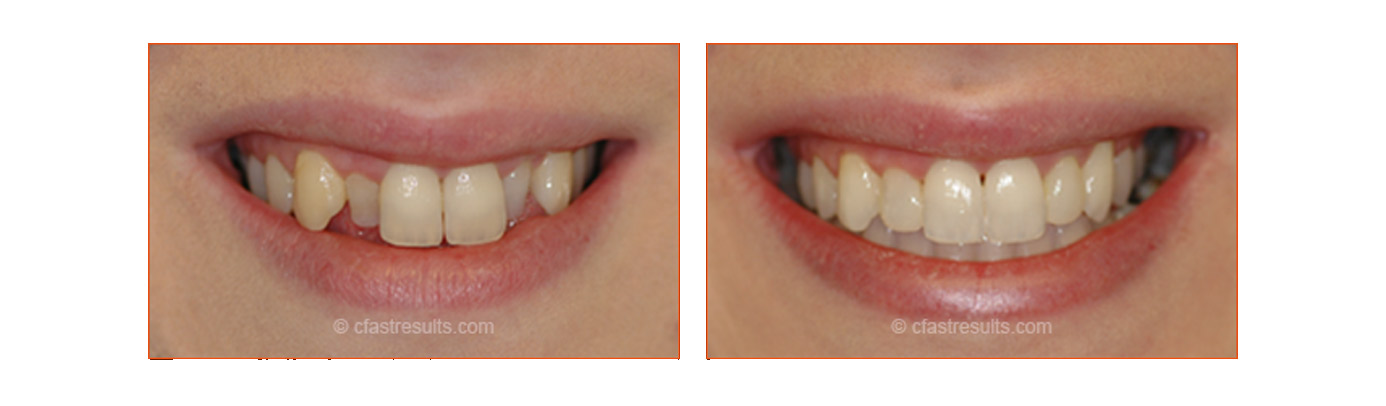 Tooth Straightening Sheffield - Cfast Tooth Alignment