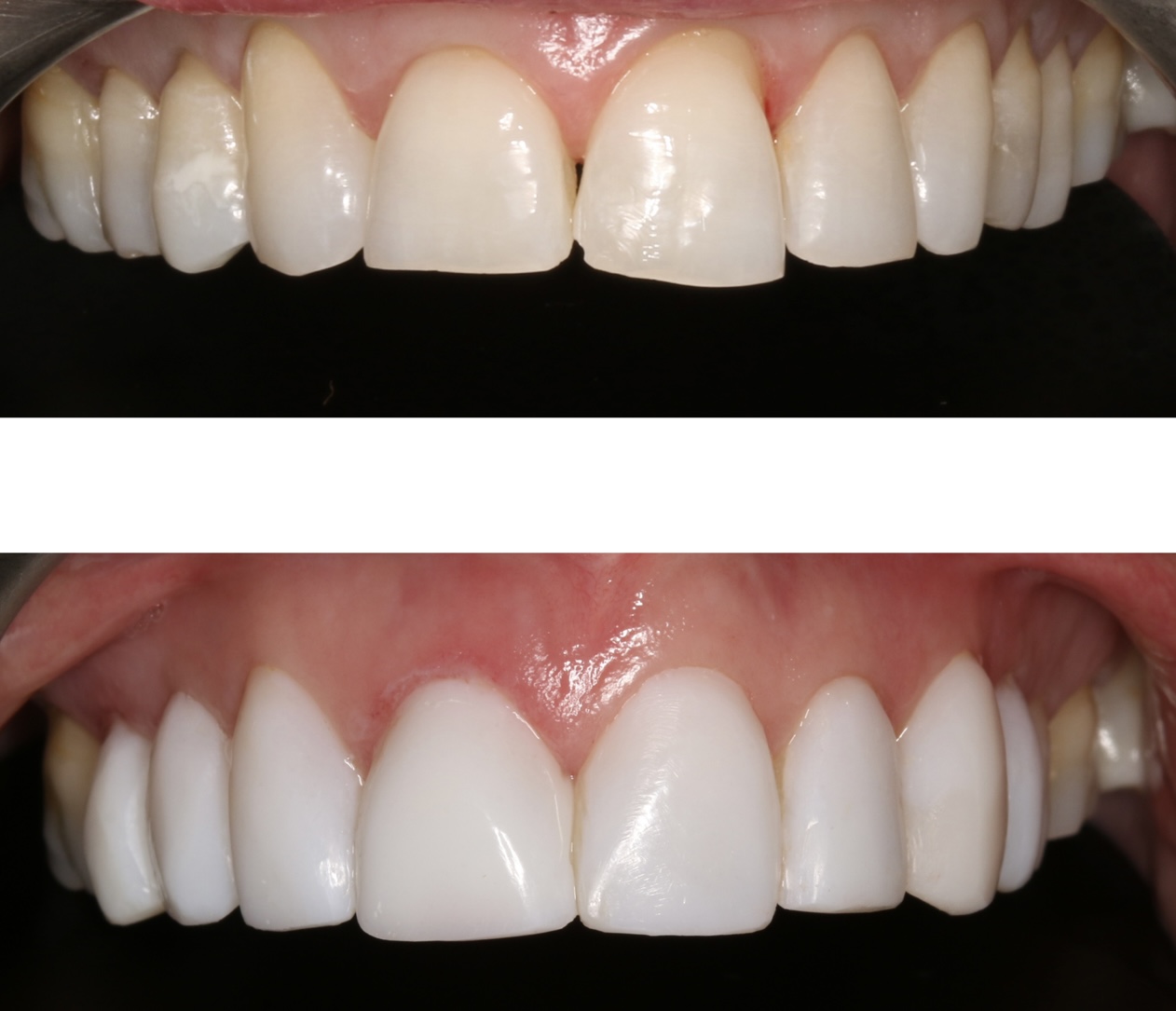 Second composite bonding before and after case at High Street Dental Care