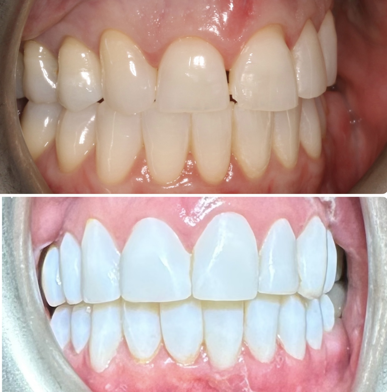 Composite bonding before and after case at High Street Dental Care