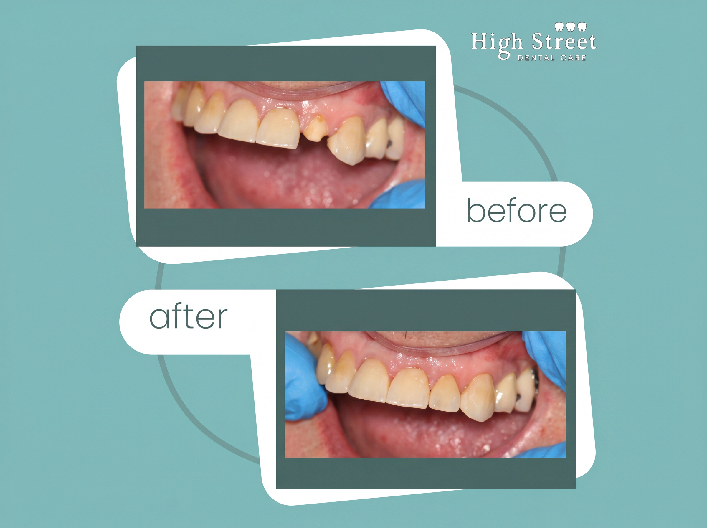 Anterior single tooth implant case at High Street Dental Care