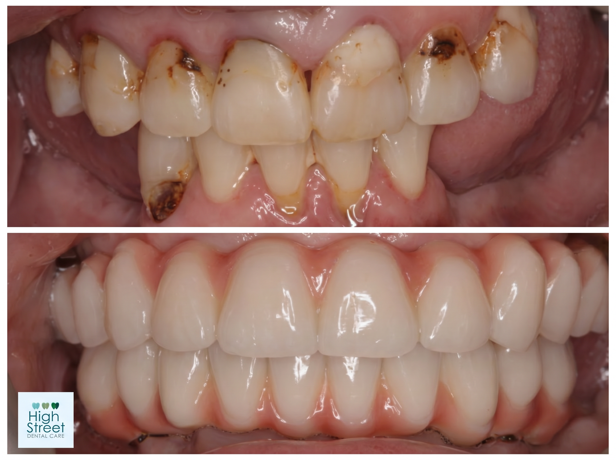 Full mouth implant rehabilitation case at High Street Dental Care