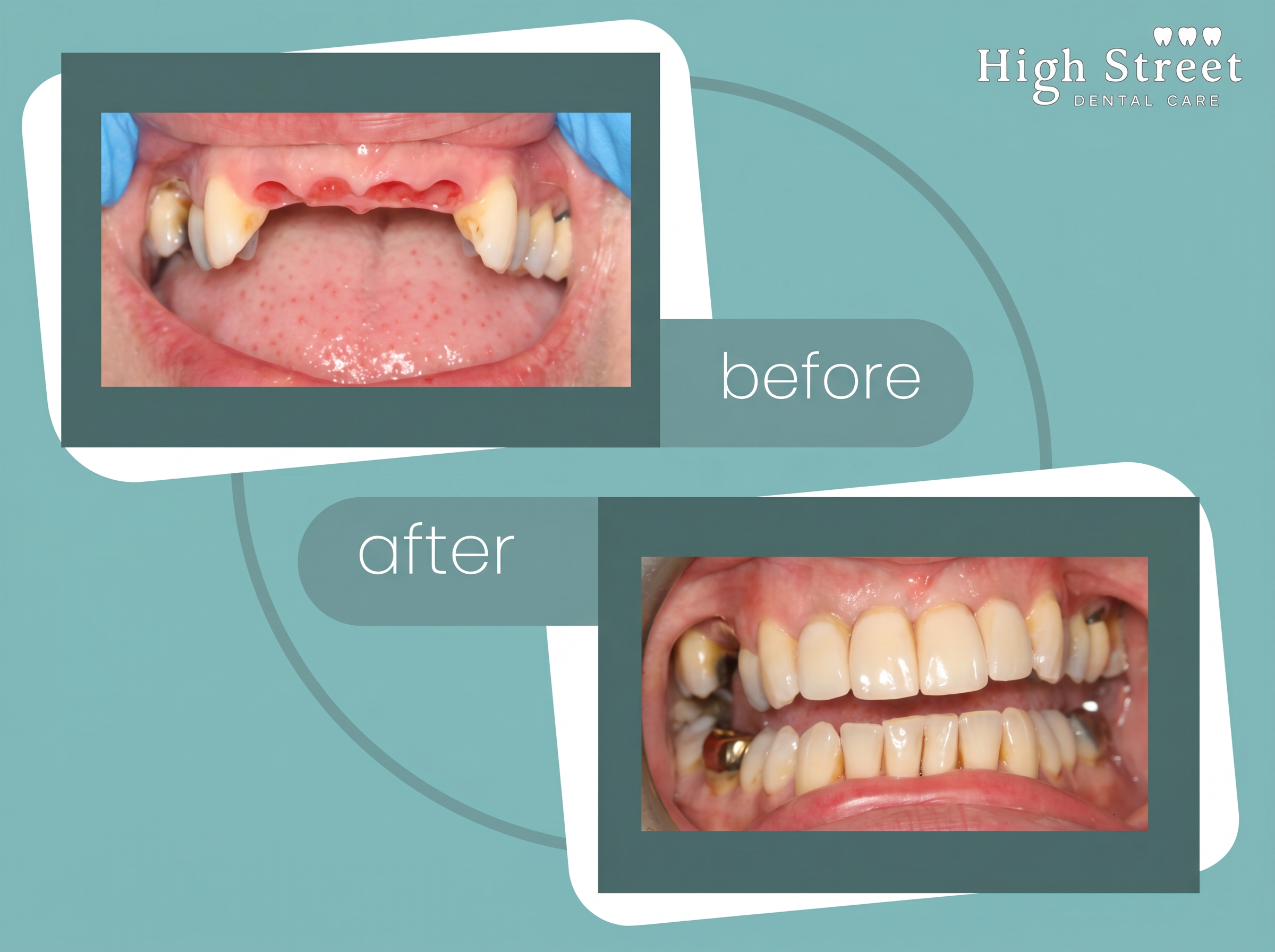 Multiple teeth implant replacement case at High Street Dental Care