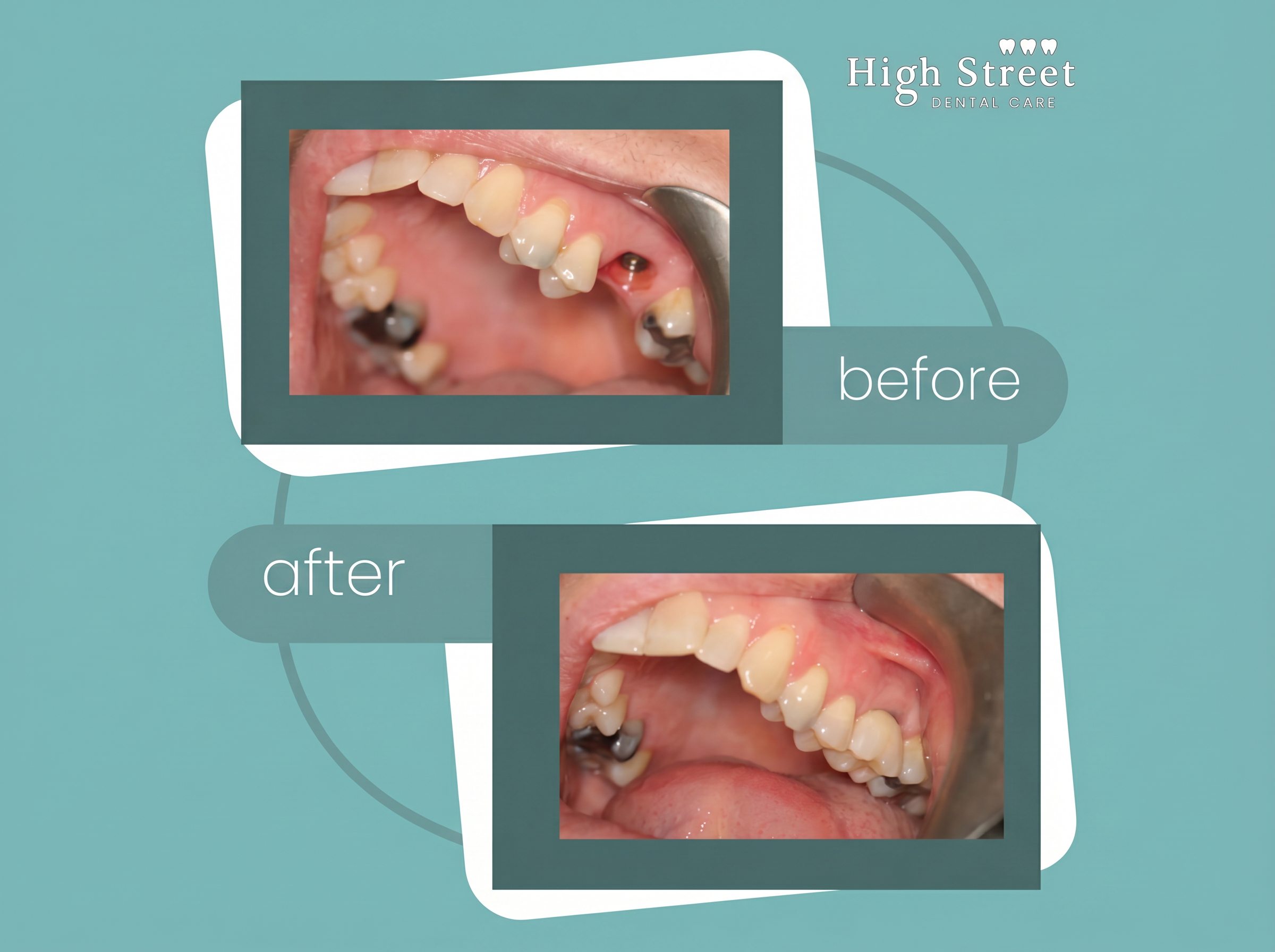 Posterior single tooth implant case at High Street Dental Care
