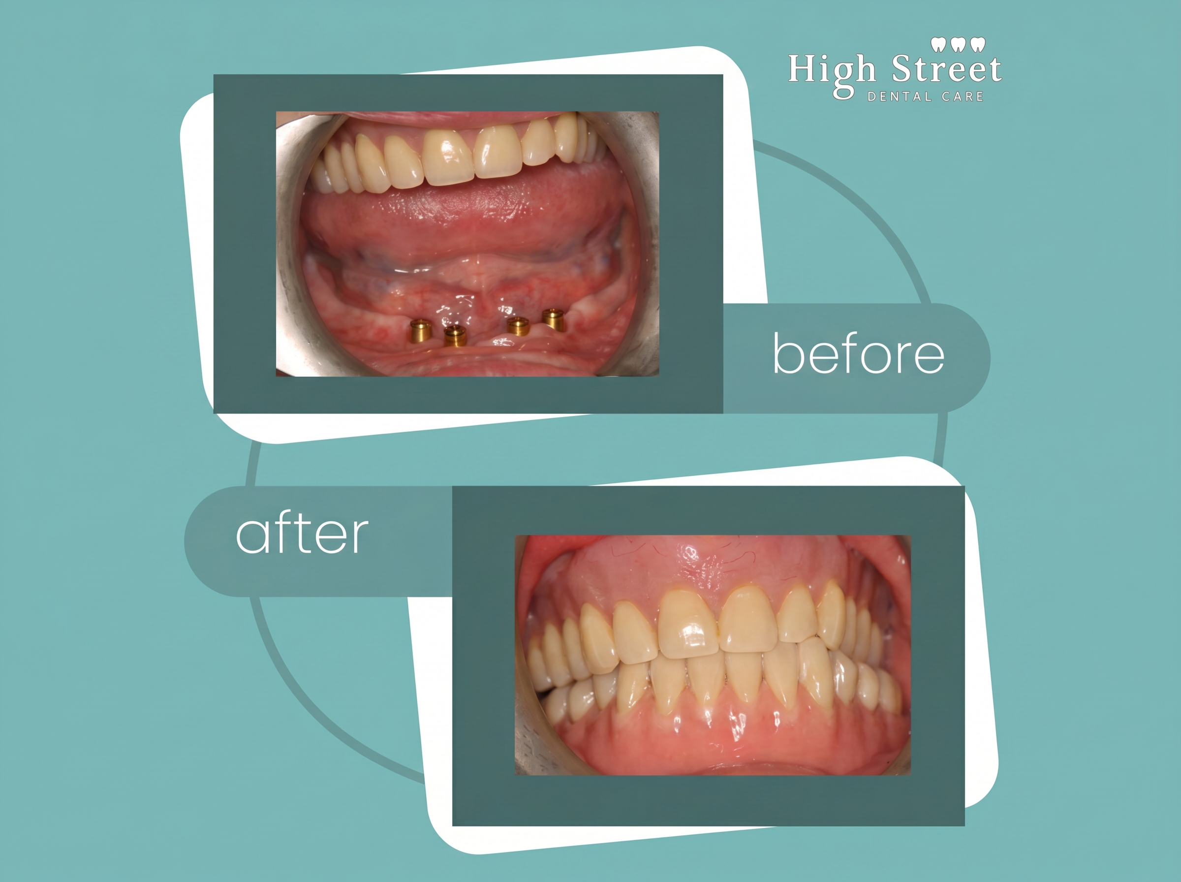 Single arch implant case at High Street Dental Care