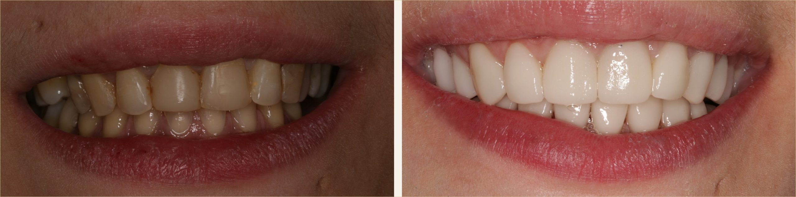Before and after smile design result at High Street Dental Care in Sheffield