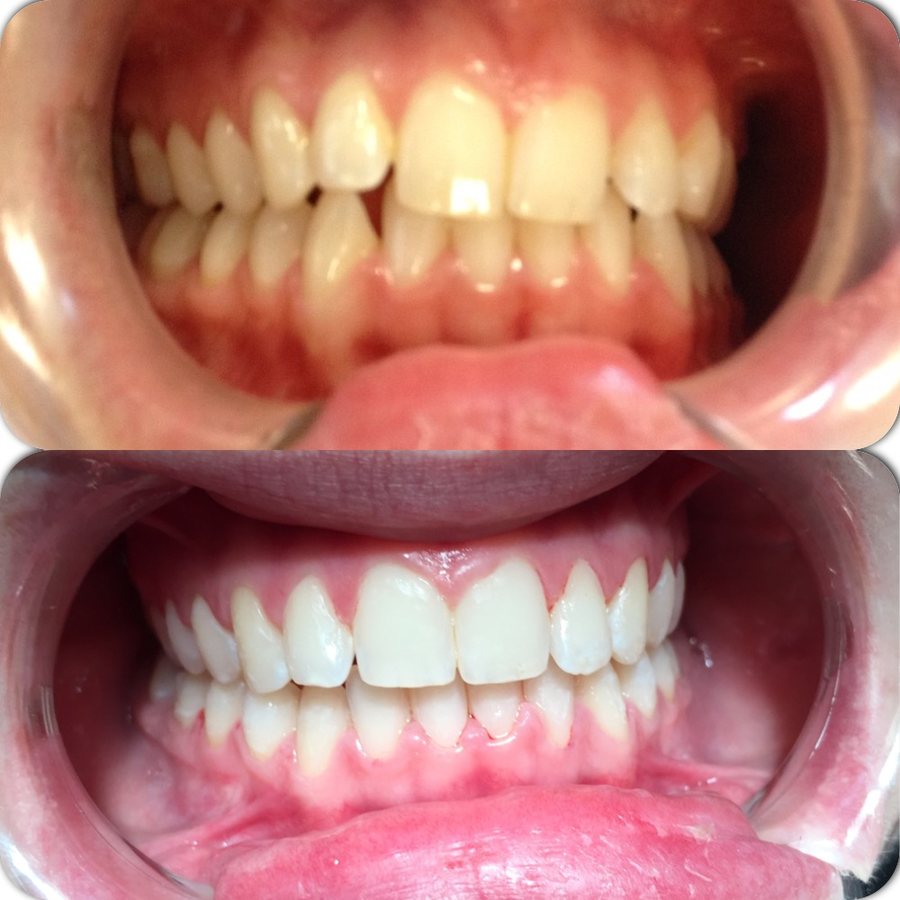 Before and after tooth straightening results at High Street Dental Care, case 1
