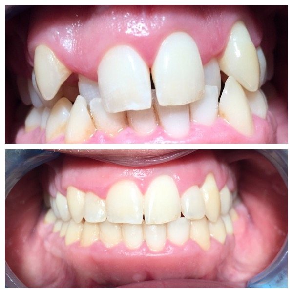 Before and after tooth straightening results at High Street Dental Care, case 2