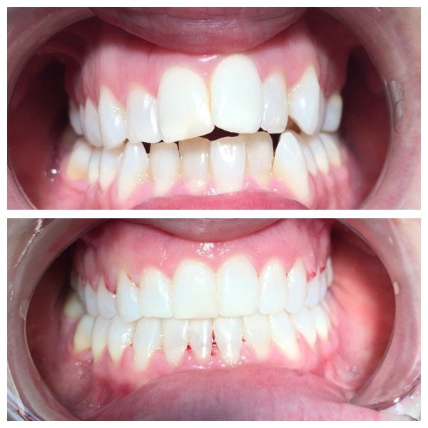 Before and after tooth straightening results at High Street Dental Care, case 3