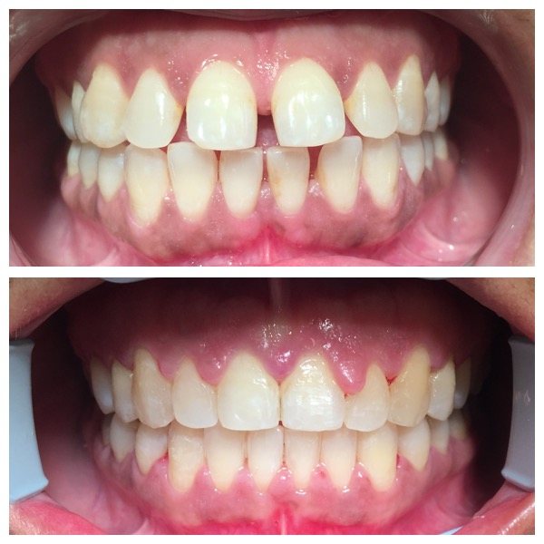 Before and after tooth straightening results at High Street Dental Care, case 4