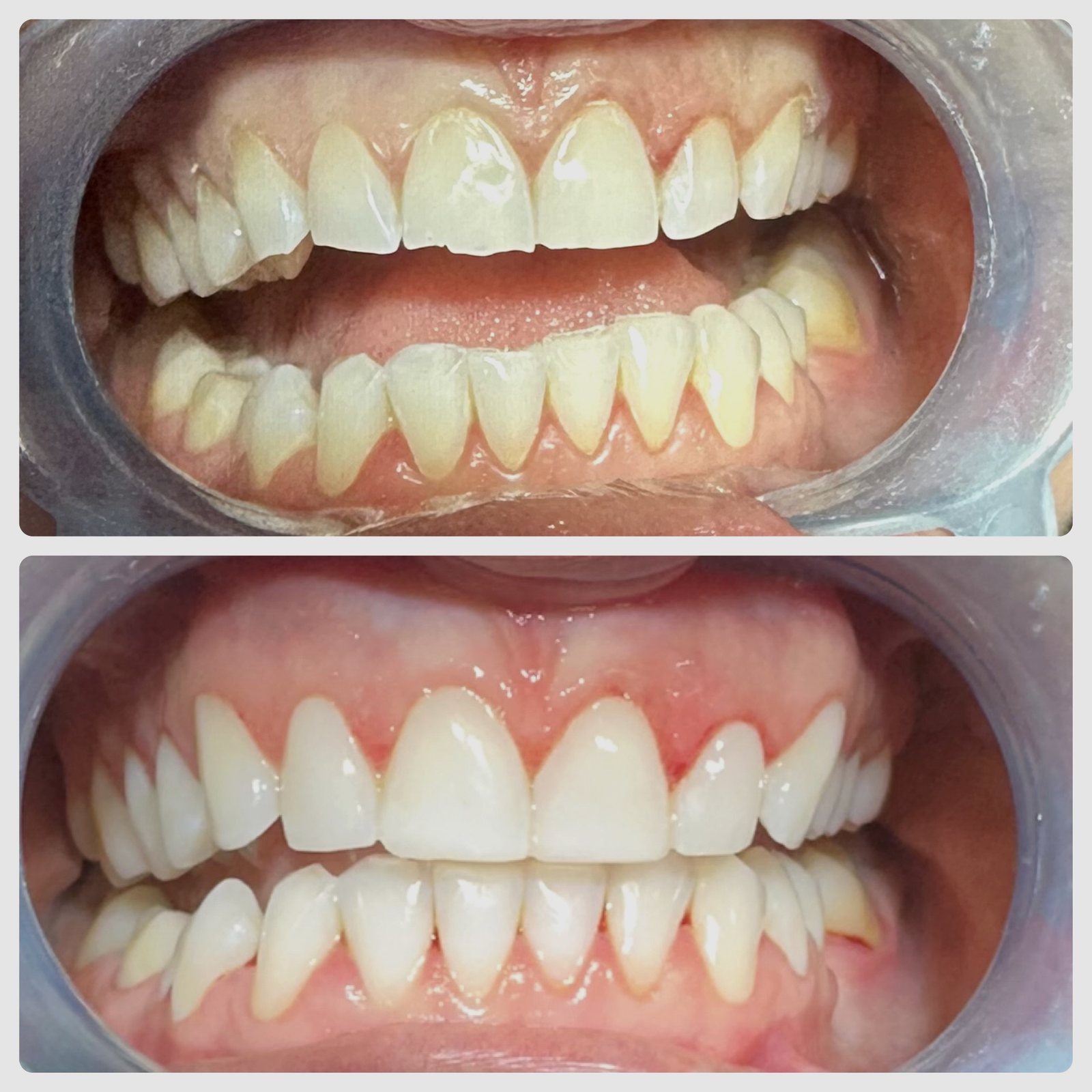 Full-arch composite bonding before and after case showing improved tooth shape, shade, smile line and edge symmetry in Sheffield
